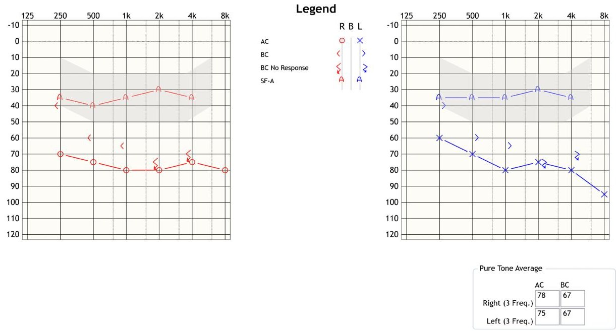 An audiogram: hearing thresholds for the right and left ears, with pure tone averages of 78 and 75 dB